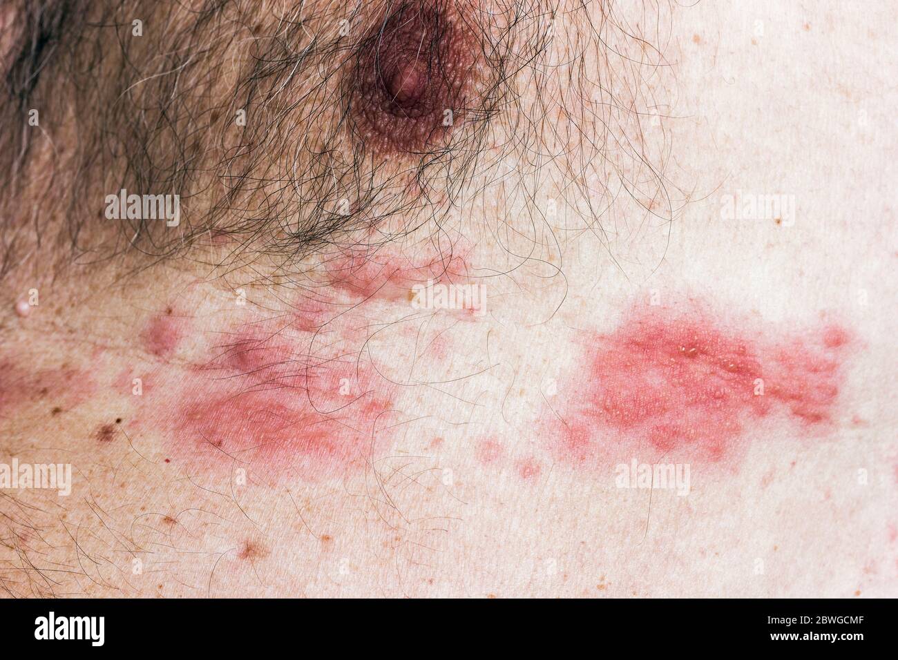 Hautausschlag von Varicella-Zoster-Virus auch als Gürtelrose auf einem älteren Mann bekannt. Stockfoto