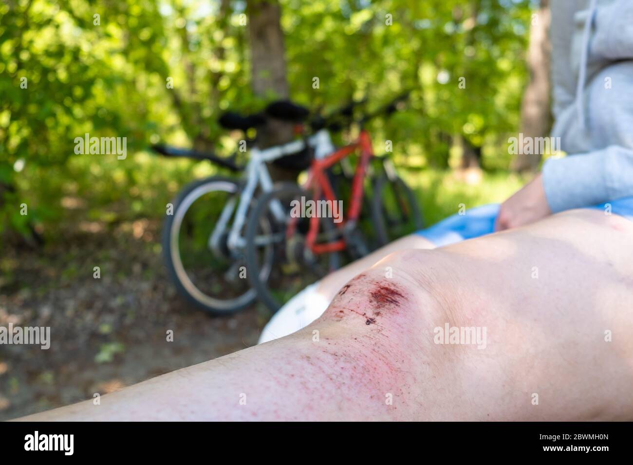 Schäden an den Beinen während Outdoor-Aktivitäten im Sommer, Radfahren. Eine offene Blutungswunde am Knie mit gereinigter Haut, Prellungen und Prellungen. Stockfoto