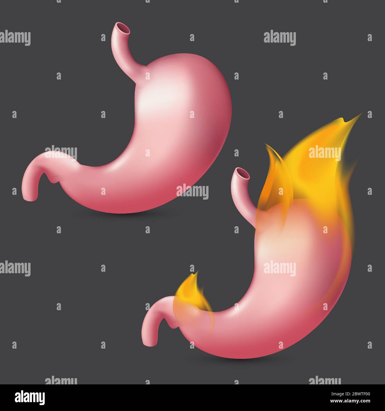 Brennender Magen. Realistische menschliche Organ der inneren Verdauung System auf Feuer. Vektor-Illustration von Sodbrennen Verdauungs-, Magen-Schmerzen oder Speiseröhre Stock Vektor