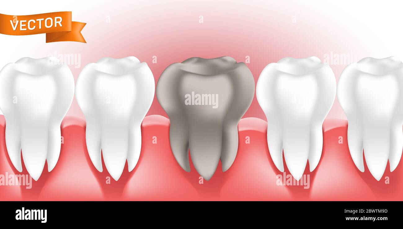 Weiß gesunde und saubere menschliche Zähne im Zahnfleisch mit Karies oder Karies, 3D-Stil Vektor-Illustration, kann als Zahn-und Medizin-Konzept el verwendet werden Stock Vektor