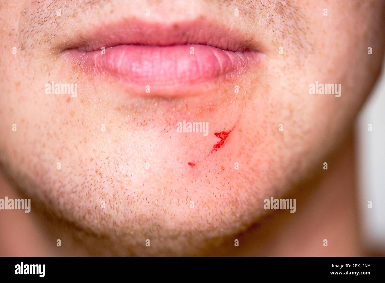 Echte kleine Wunde oder Schnitt auf der Haut, Wunde auf Gesicht des  Menschen, Nahaufnahme des Kinns Stockfotografie - Alamy