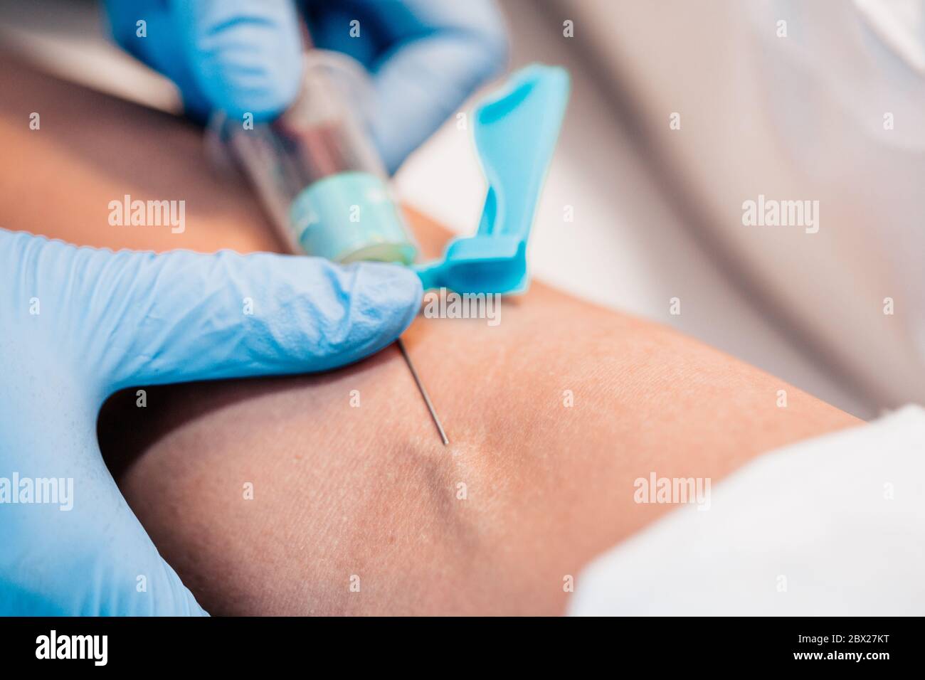 Plasma-Lifting - Nahaufnahme der Hand des Arztes - Bluttest aus der Vene - Diagnose Stockfoto