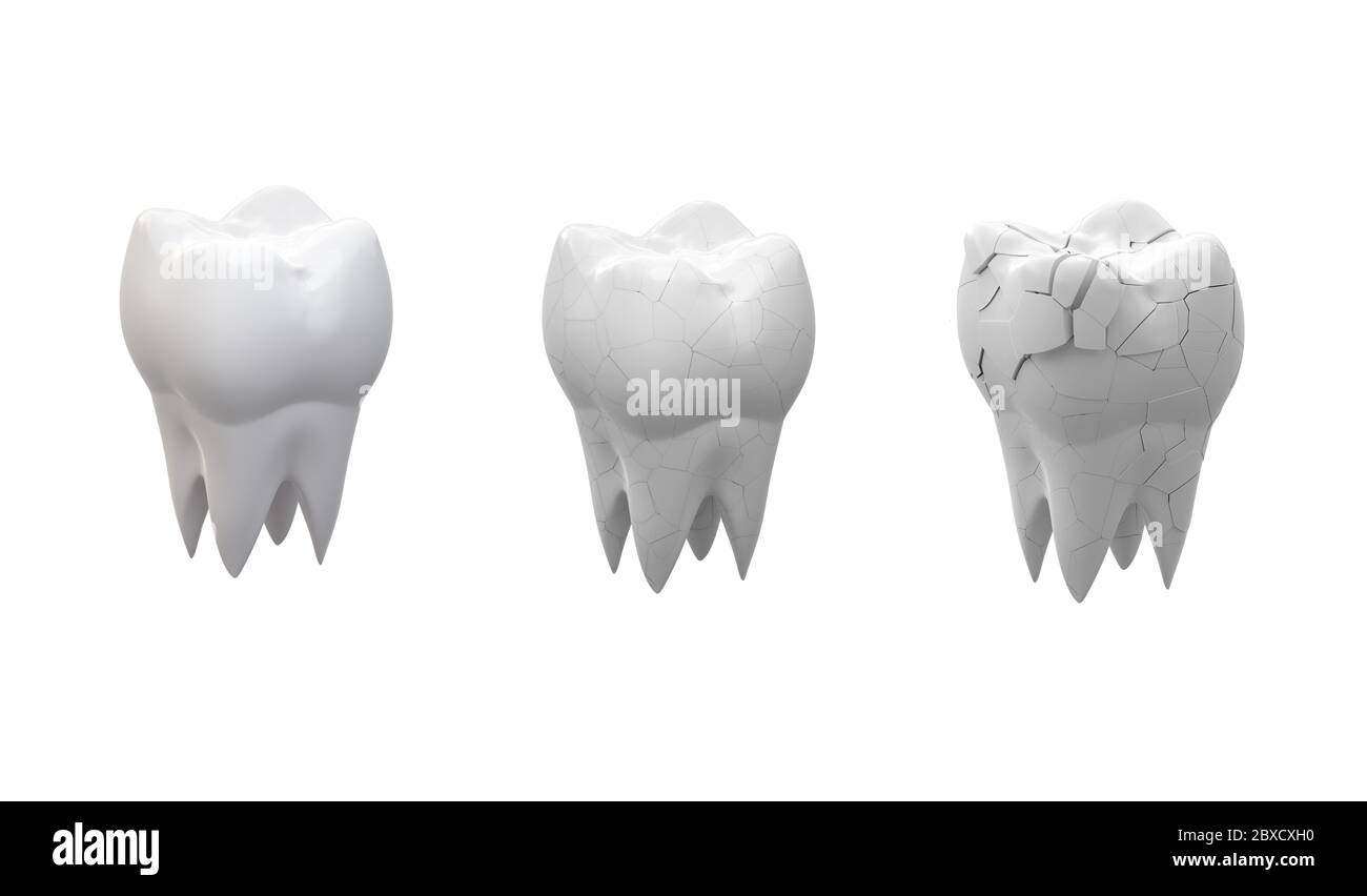 Gebrochene Backenzähne Zahn und ganzer Zahn isoliert auf weißem Hintergrund. 3d-Illustration Stockfoto