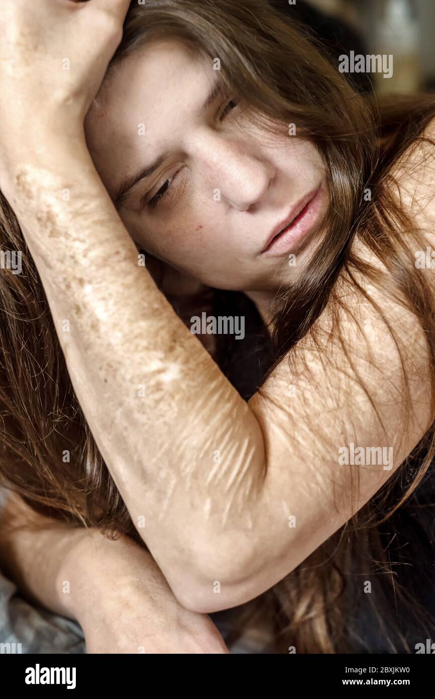 Porträt und Arm einer Frau mit schweren Schnitten und Narben der Selbstverstümmelung in Frustration, Selbstmissbrauchs, Borderline-Persönlichkeitsstörung, Stockfoto