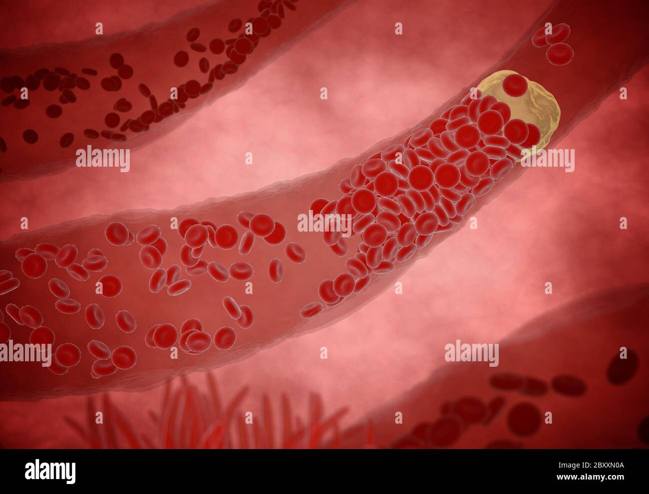 Verstopfte Arterie mit Blutplättchen und Cholesterin Plaque, Konzept für das Gesundheitsrisiko Adipositas oder Diät-Probleme. 3d-Rendering Stockfoto