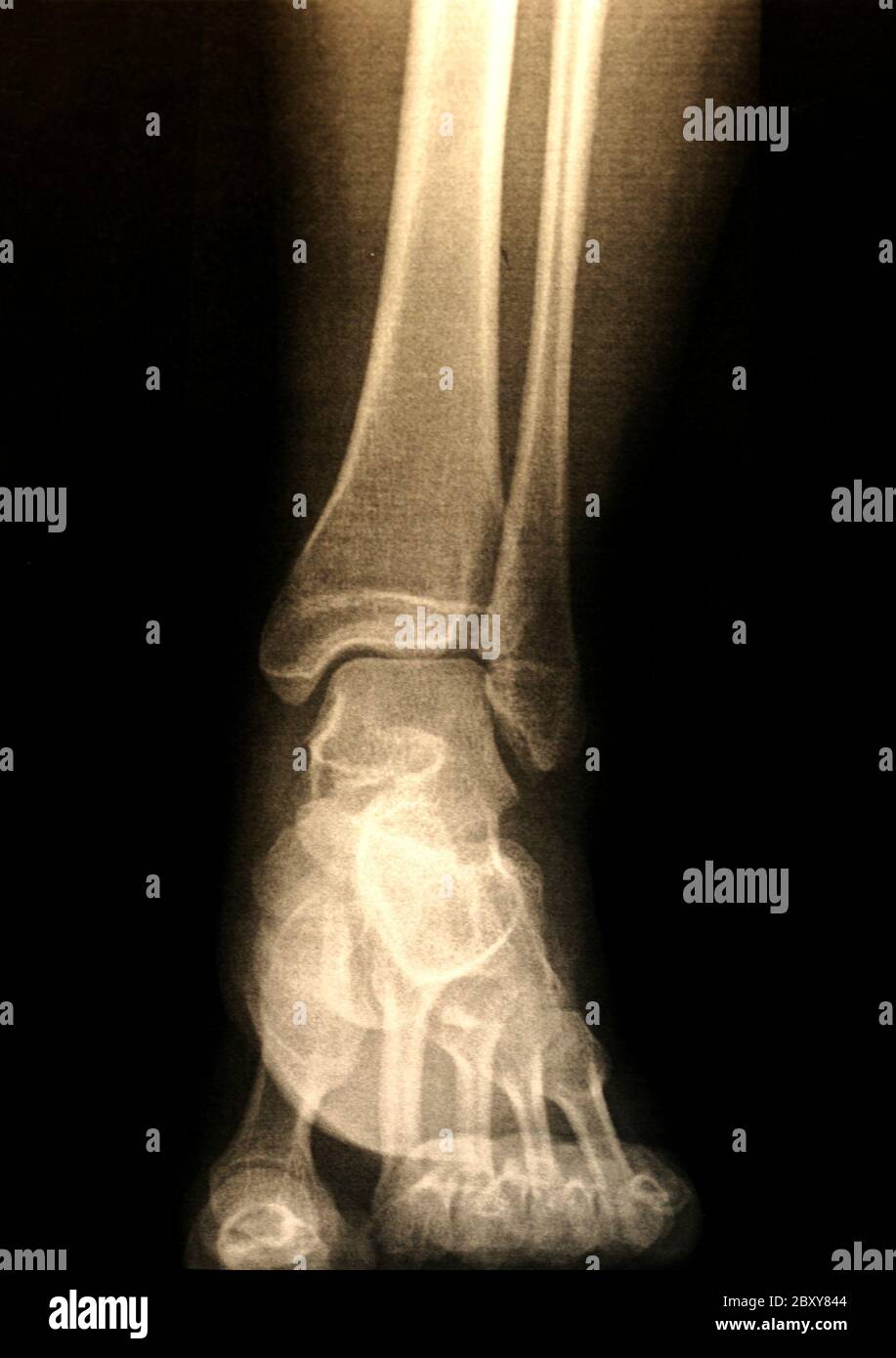 Ein X-ray von einem Fuß Stockfoto