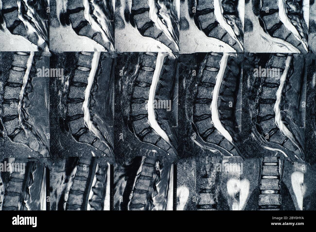Makroaufnahme der Lendenwirbelsäule mit Osteochondrose, altersbedingten Veränderungen der Bandscheiben der Wirbel und eingeklemmten Nerven. Stockfoto