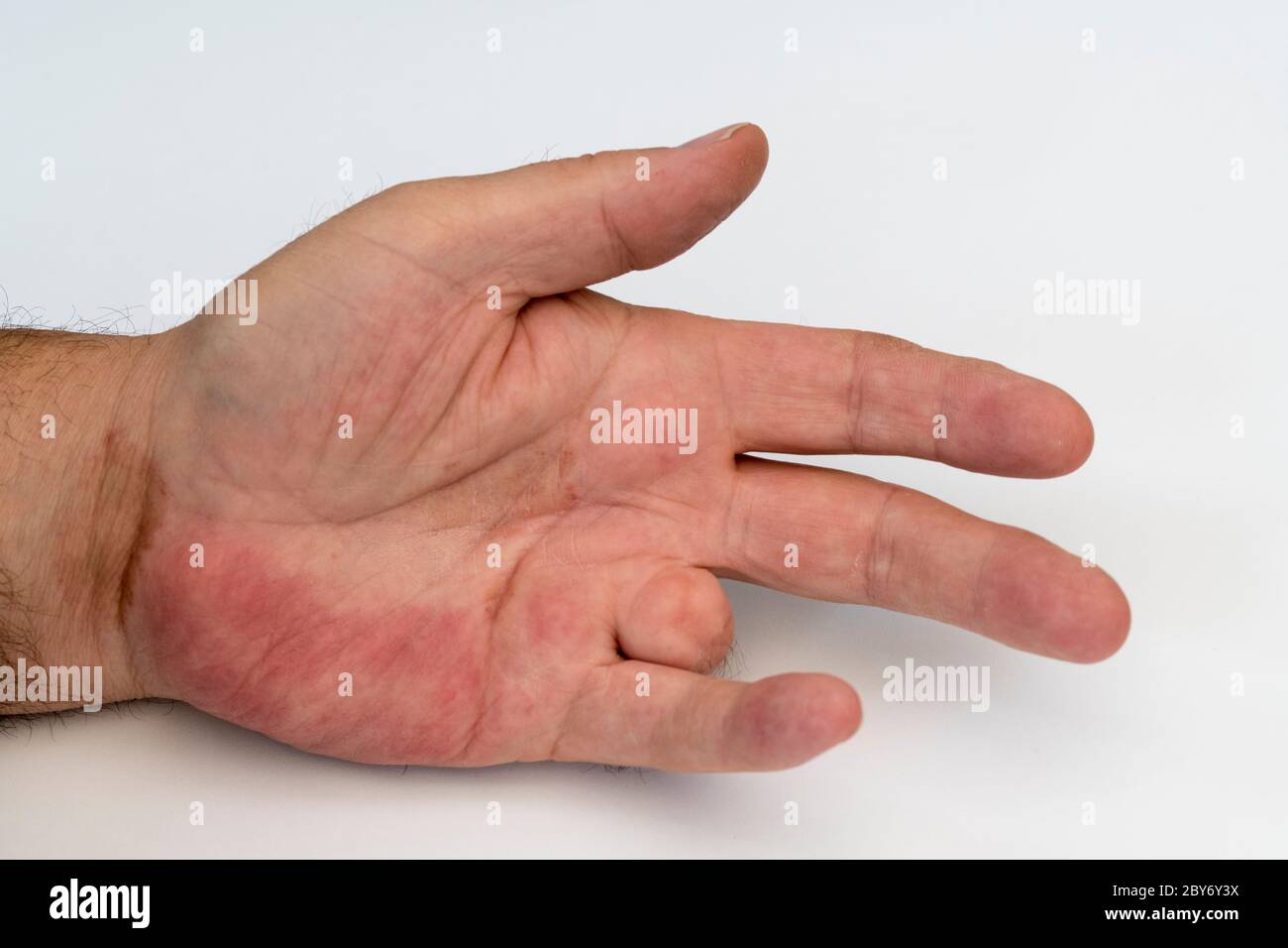 Finger taub hand linke ringfinger kleiner und Kleiner Finger