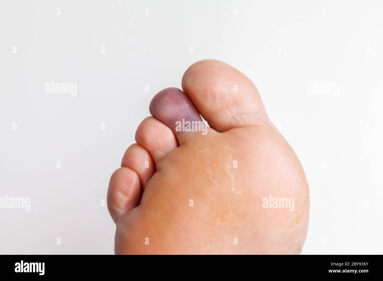 Gequetscht Zehen, Rechter Fuß Stockfoto