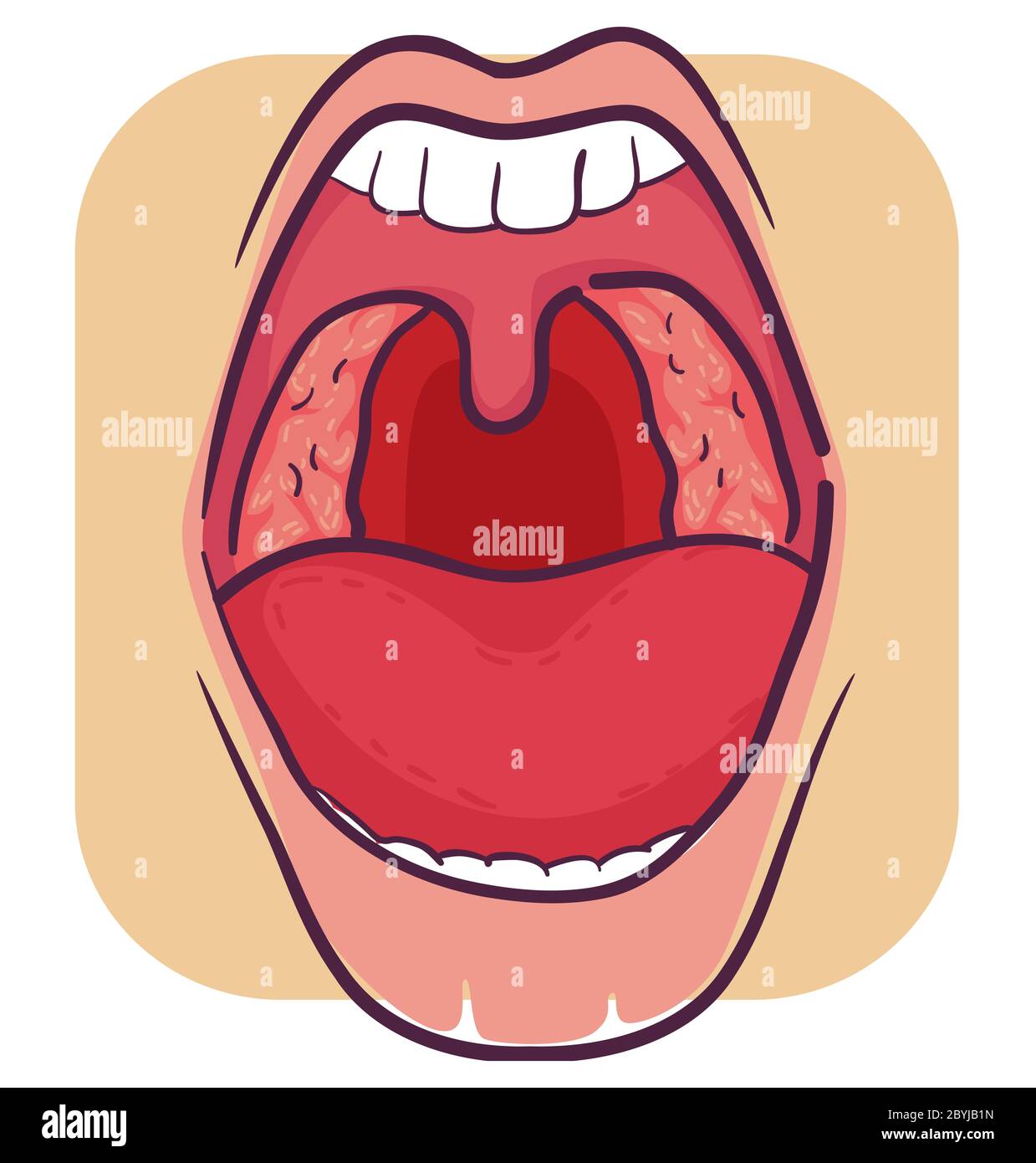 Illustration von weit geöffnetem Mund mit entzündeten Mandeln, Symptom der Tonsillitis Stockfoto