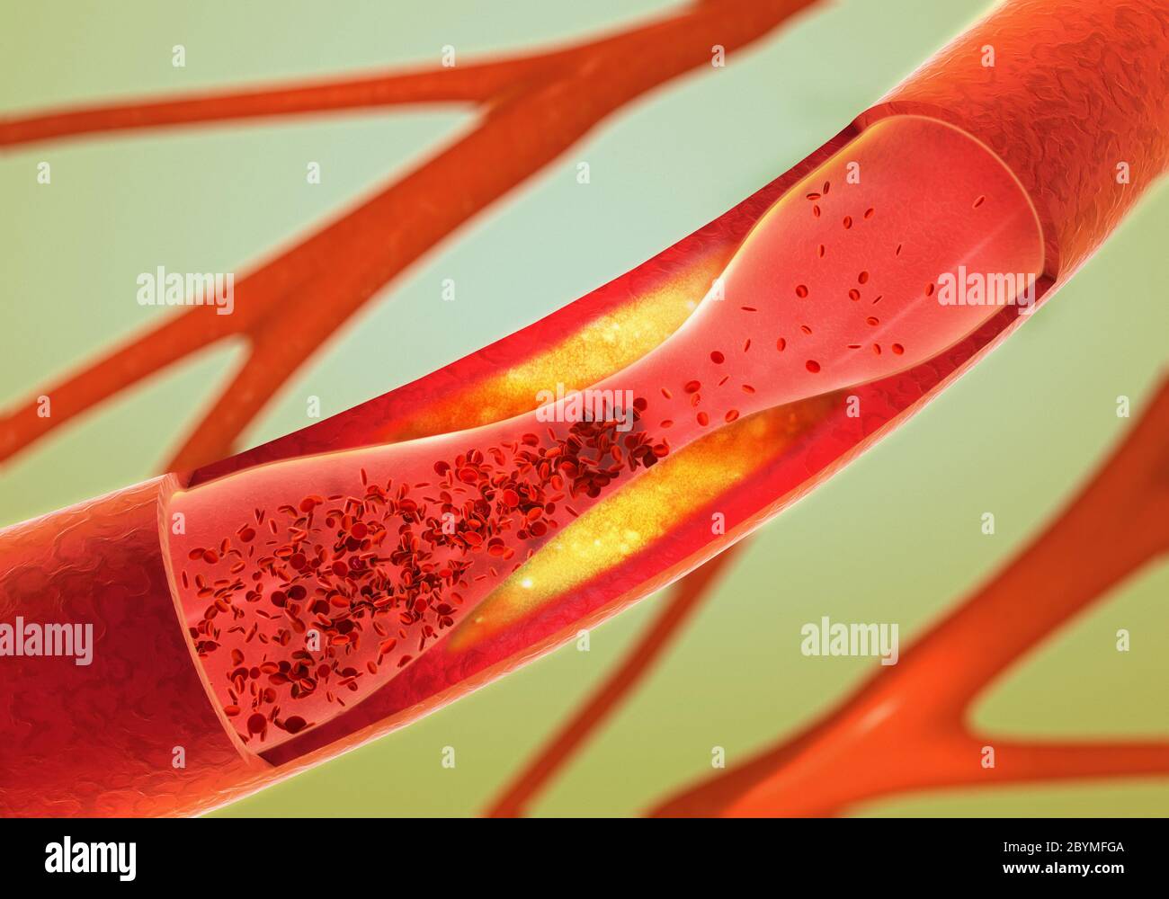 Niederschlag und Verengung der Blutgefäße - die Arteriosklerose Stockfoto