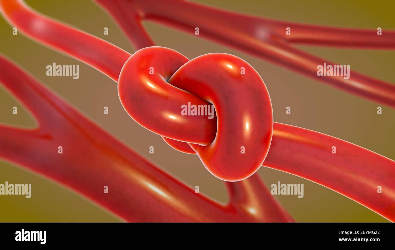 3D-Darstellung eines Knoten in einer Arterie verengt wird und verengten Arteriosklerose genannt Stockfoto