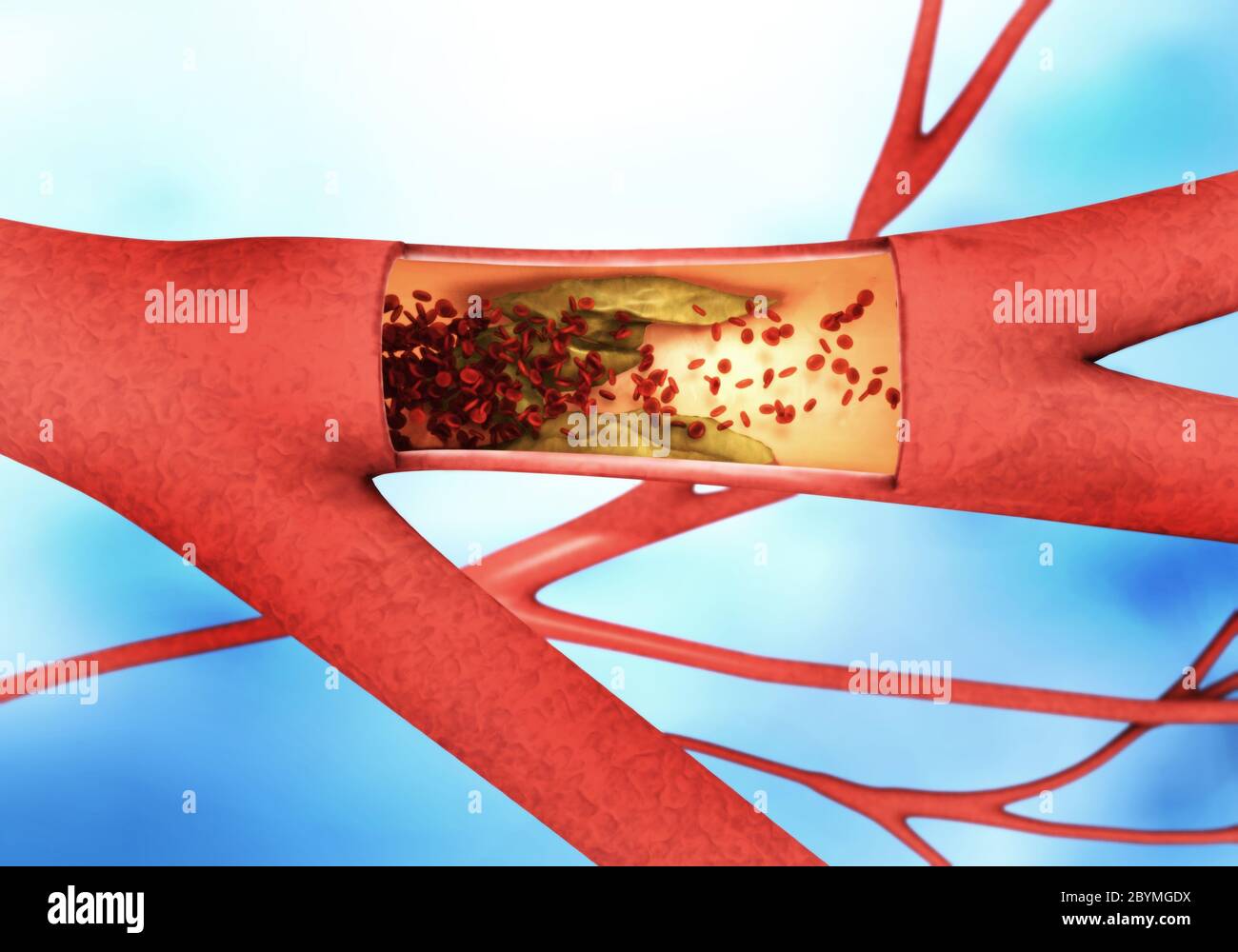 Querschnitt eines auslösenden oder Verengung der Blutgefäße so genannten Arteriosklerose. Stockfoto