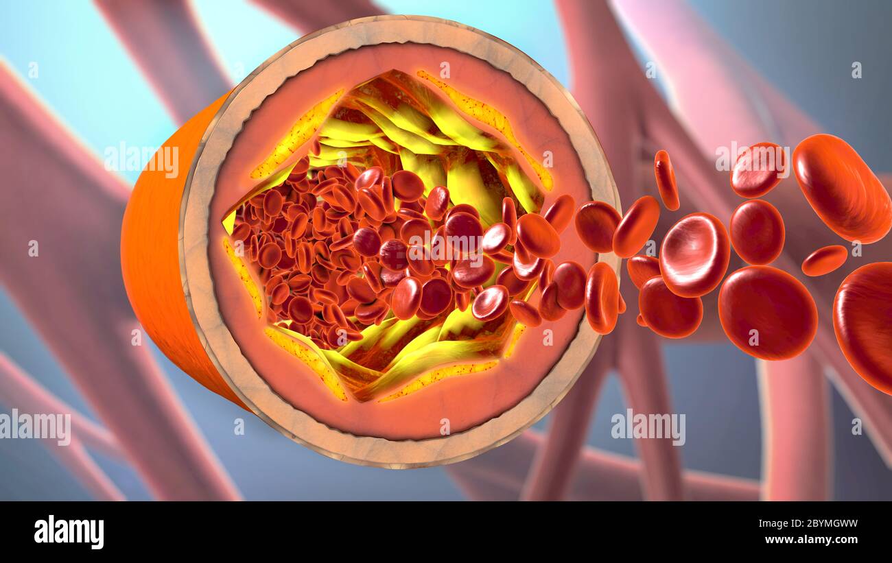 3D-Darstellung eines ausgefällt und Verengung der Blutgefäße oder Arteriosklerose Stockfoto