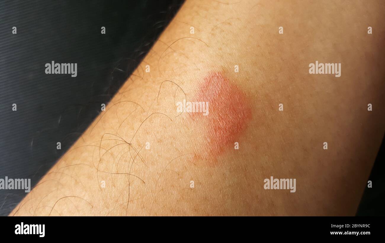 Nahaufnahme Tausendfüßler Biss, giftig verletzt Arm Stockfoto