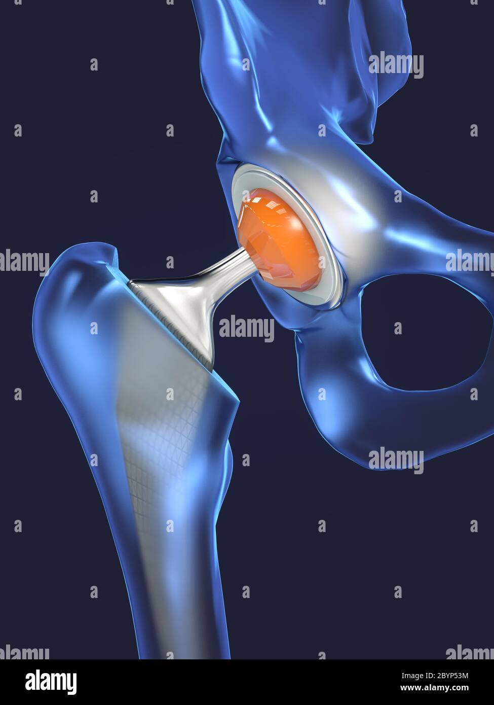 Funktion eines Hüftgelenkimplantats oder einer Hüftprothese in der Frontalansicht - 3d-Illustration Stockfoto