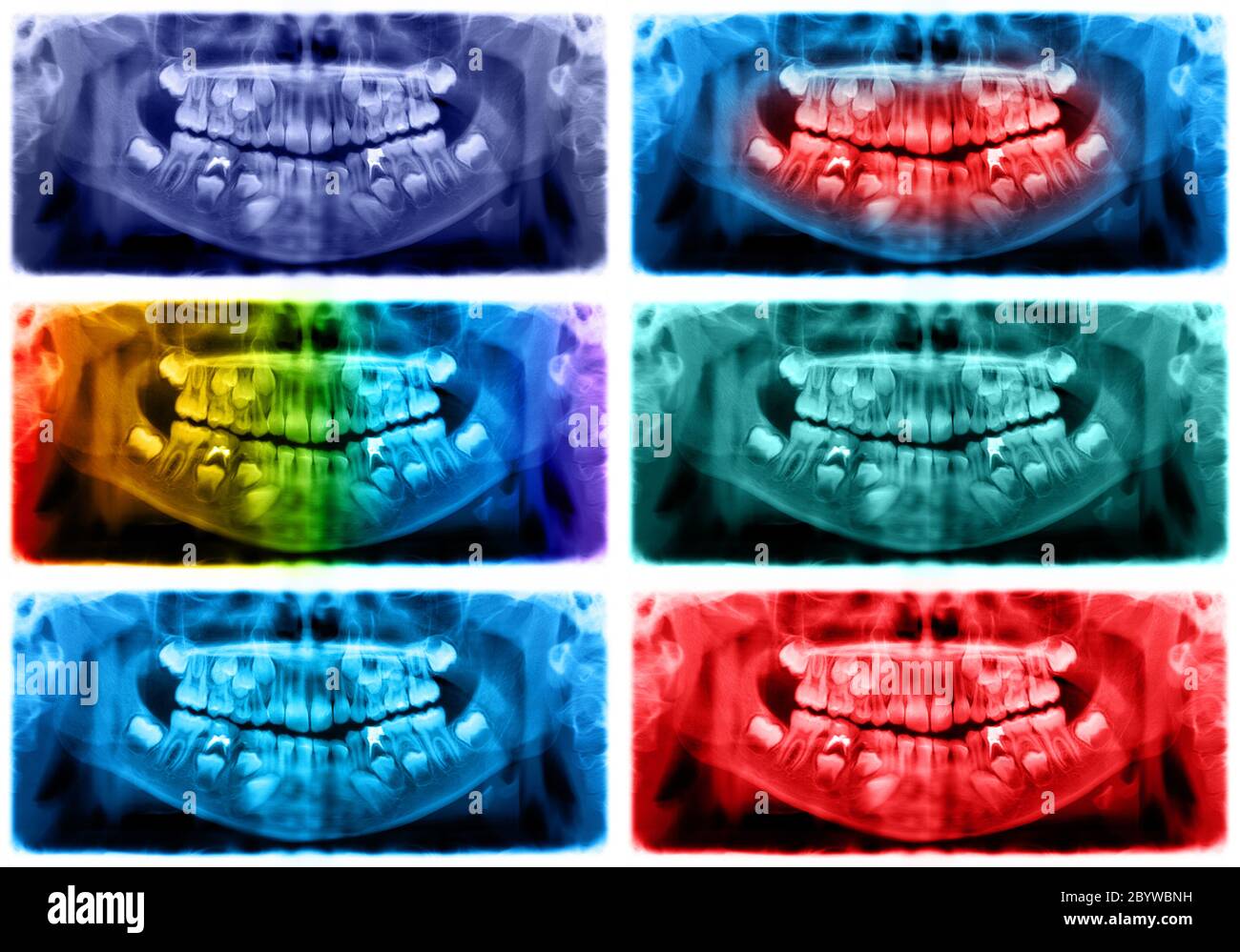 Panorama-Röntgenaufnahme ist eine Scan-dentale Röntgenaufnahme des Oberkiefers Oberkiefer Oberkiefer und Unterkieferknochen Unterkiefer. Das Foto zeigt ein Kind im Alter von 7 sieben Jahren Stockfoto