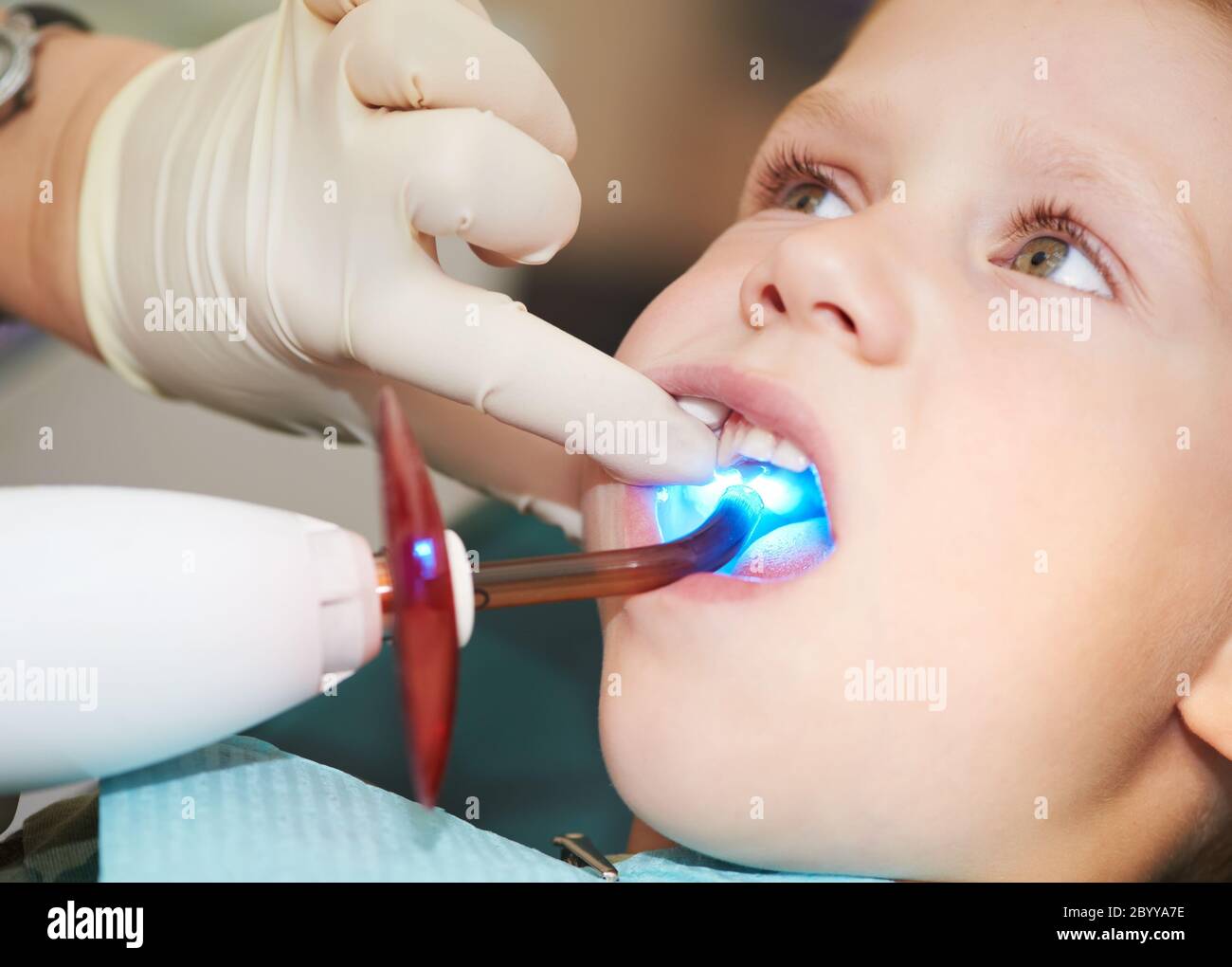 Zahnfeilung von Kinderzahnzahnes durch ultraviolettes Licht Stockfoto