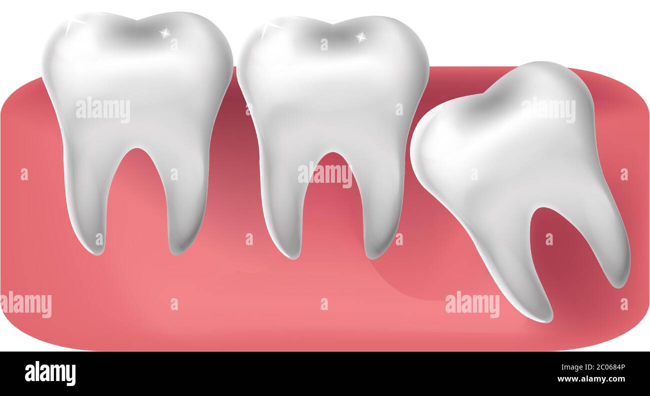 Weisheit Zahn durch geschnitten, 3d-realistische Stil. Zahnmedizin, Weisheit Zähne Extraktion Konzept. Vektorgrafik Stock Vektor