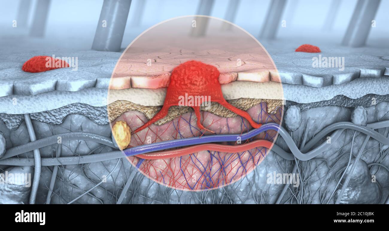 3D-Darstellung der Querschnitt einer kranke Haut mit Melanomen, die in die Blutbahn und lymphatische Trakt Stockfoto