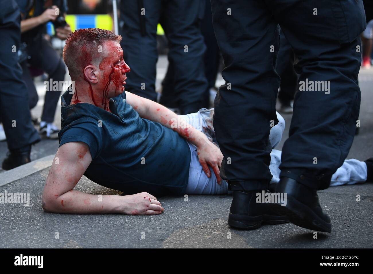 GRAFISCHE INHALTE BEACHTEN EIN Protestant mit Gesichtsverletzungen, nachdem er vor dem Bahnhof Waterloo in London angegriffen wurde. Stockfoto