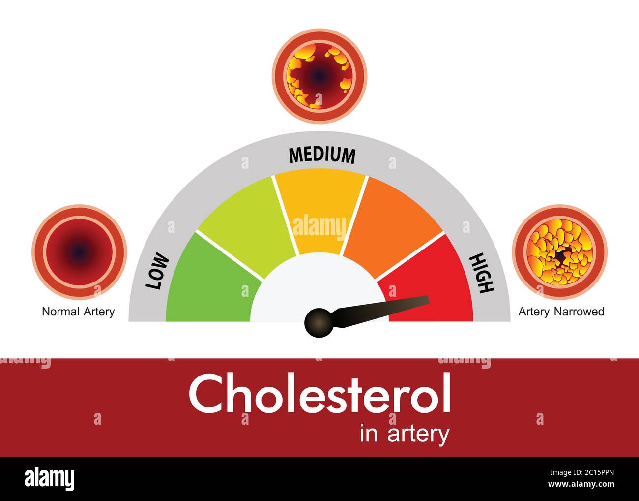 Cholesterin in der Arterie, Gesundheitsrisiko, Vektor-Design Stock Vektor Cholesterin in der Arterie, Gesundheitsrisiko, Vektor-Design Stock Vektor