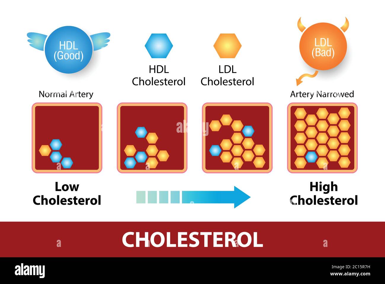 Cholesterin in der Arterie, Gesundheitsrisiko, Vektor-Design Stock Vektor Cholesterin in der Arterie, Gesundheitsrisiko, Vektor-Design Stock Vektor