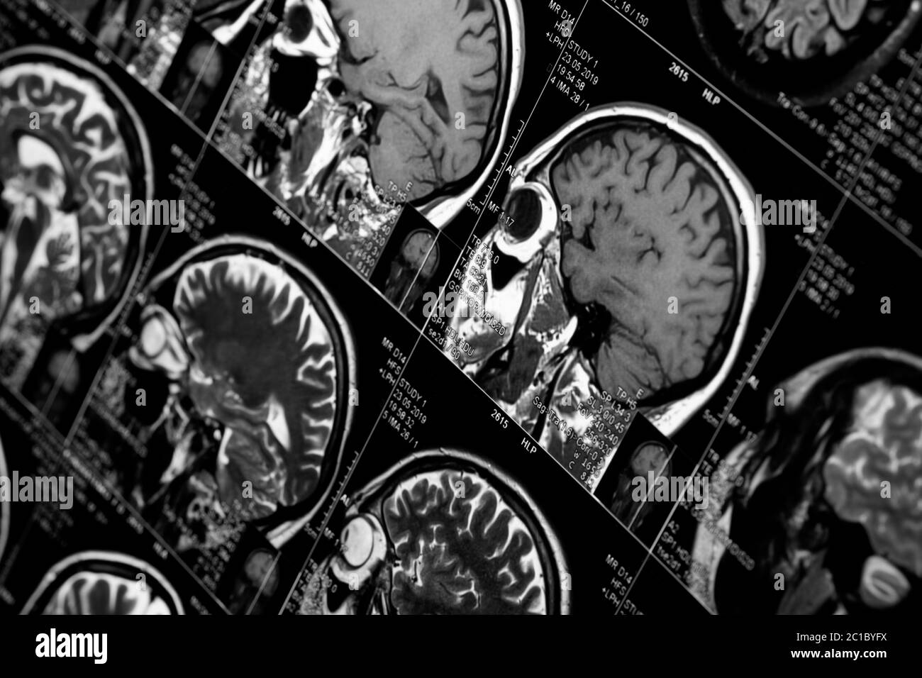 MRT-Untersuchung des menschlichen Gehirns, schwarz und weiß Stockfoto