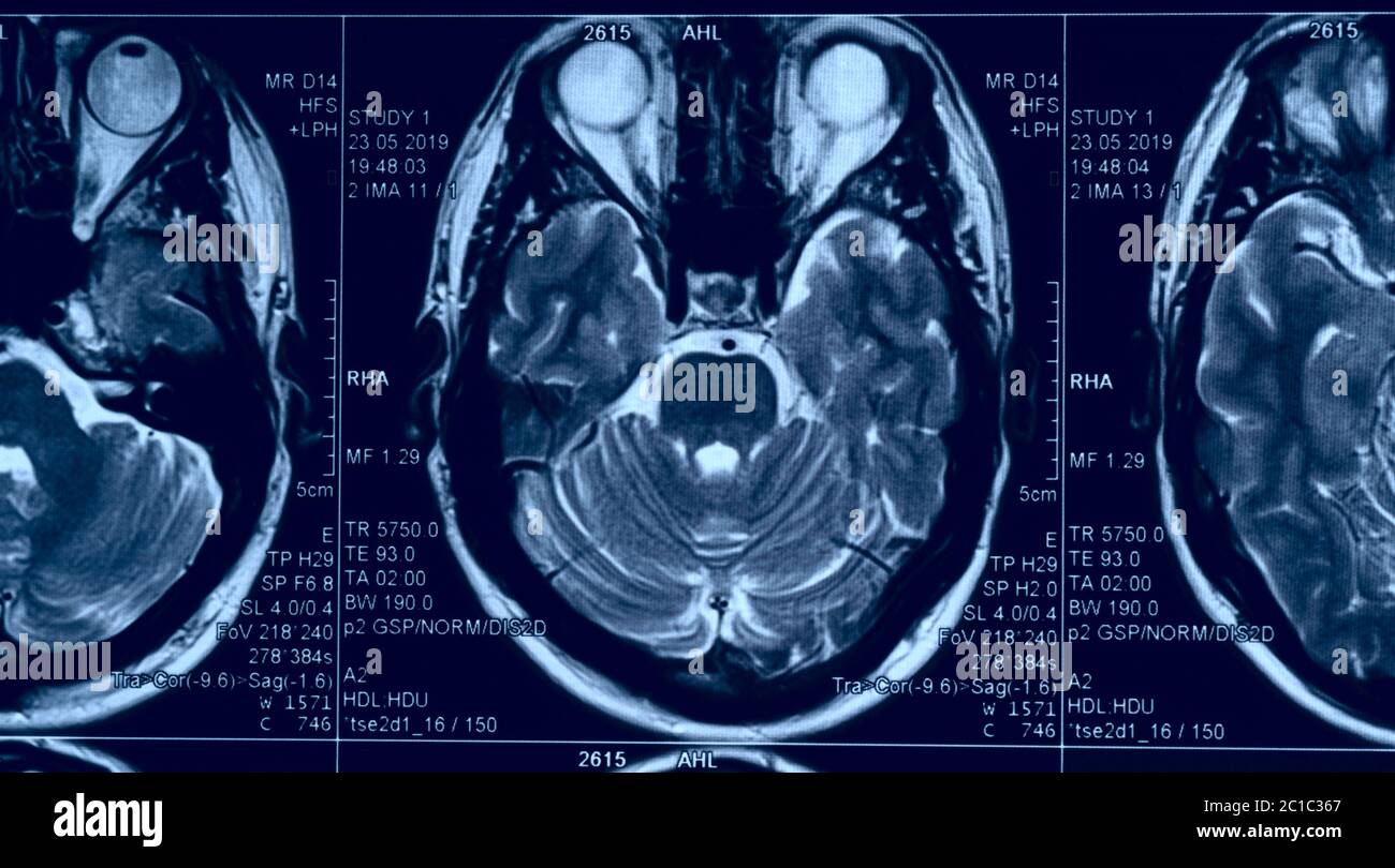Gehirn MRT-Folie eines jungen Mannes, Augen sind zu sehen Stockfoto