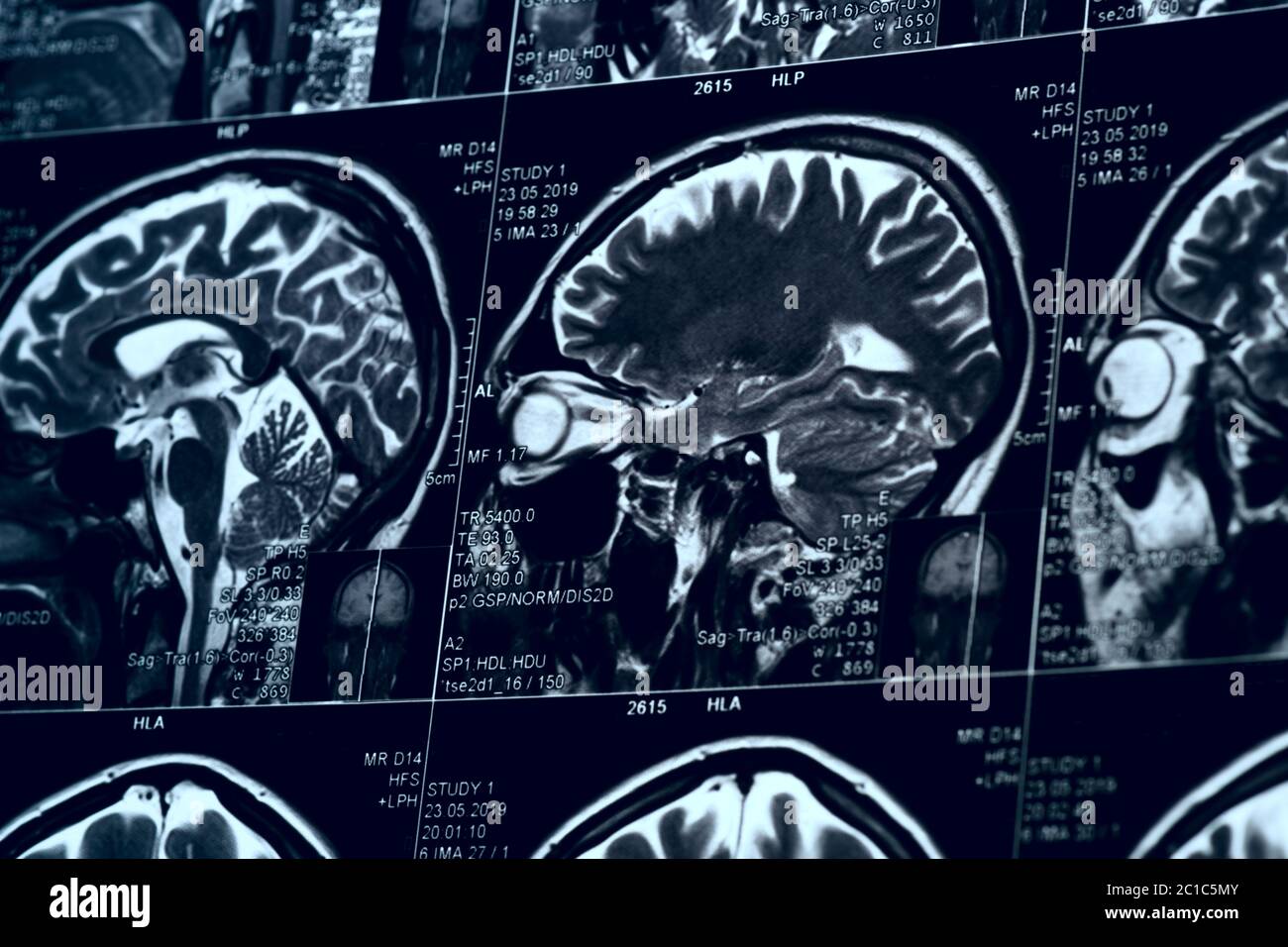 MRT-Untersuchung des menschlichen Gehirns, getöntes Bild Stockfoto