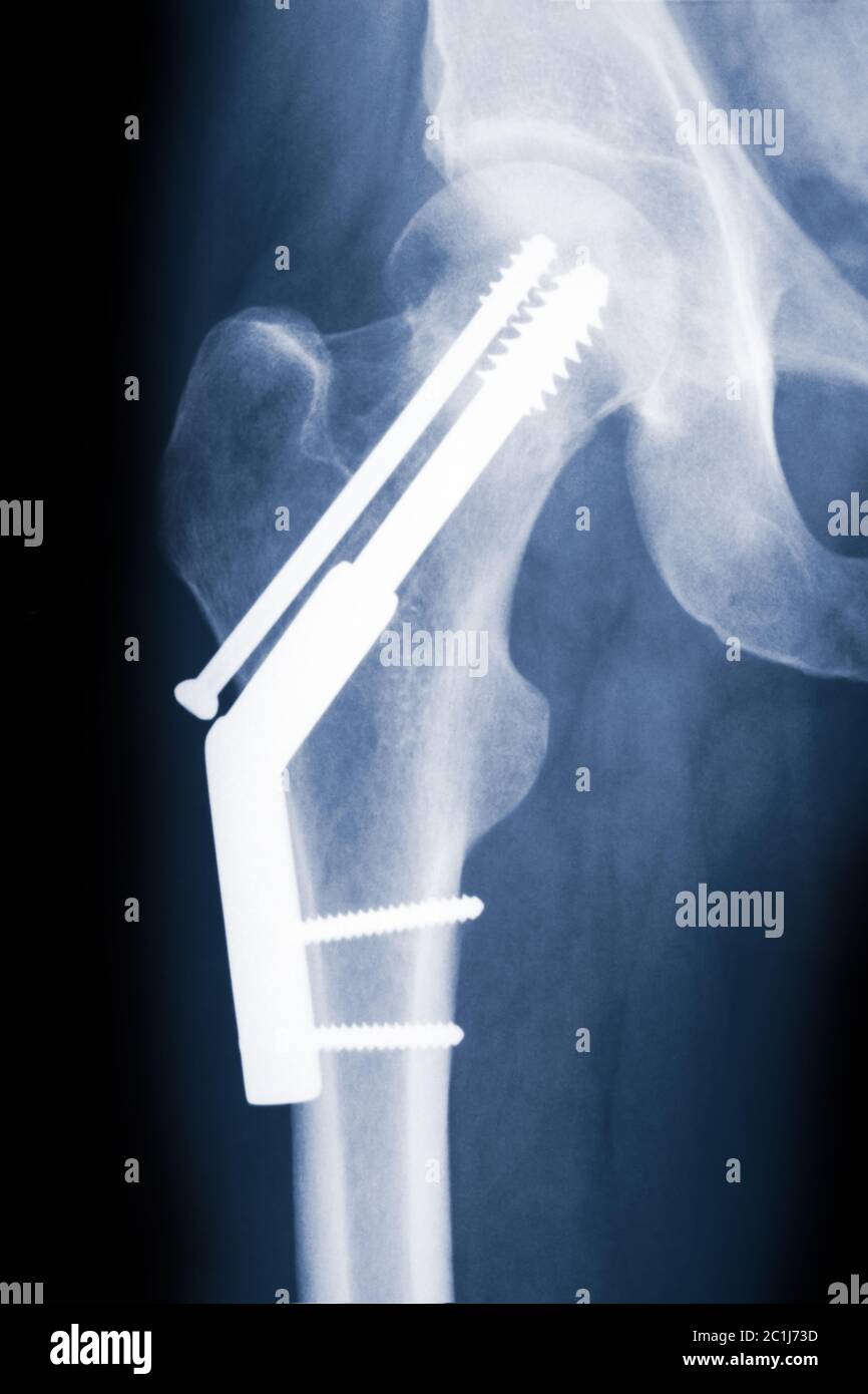Hip-Röntgenaufnahme mit Fixierung einer gebrochenen Hüfte mit einer dynamischen Hüftschraube und einer Anti-Rotations-Schraube. Stockfoto