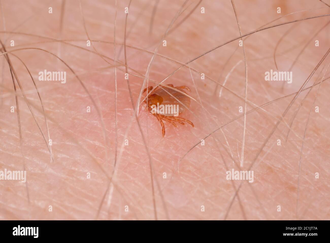 Trinken Blut beißen die menschliche Haut Tick Stockfoto