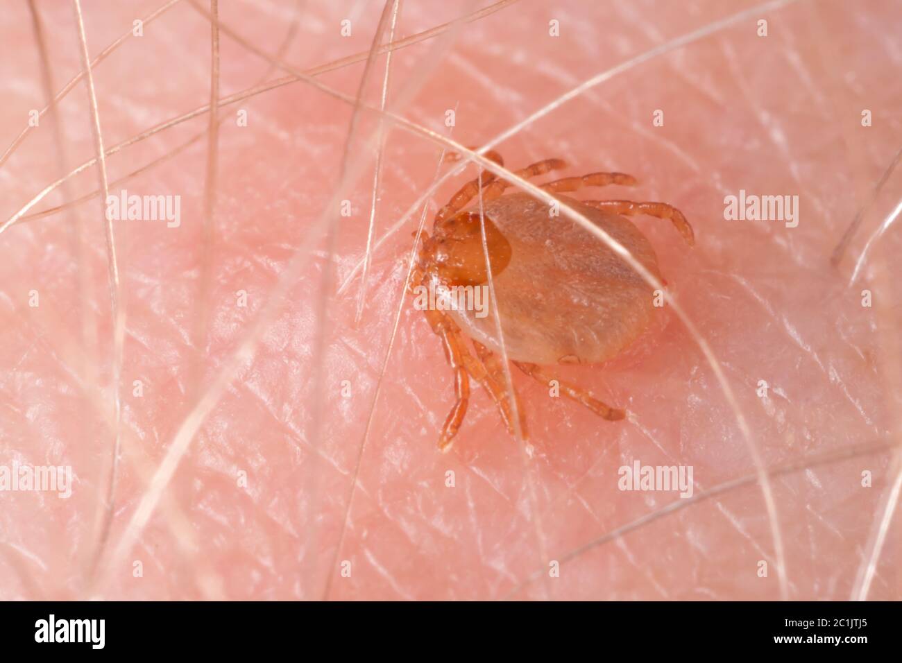 Trinken Blut beißen die menschliche Haut Tick Stockfoto