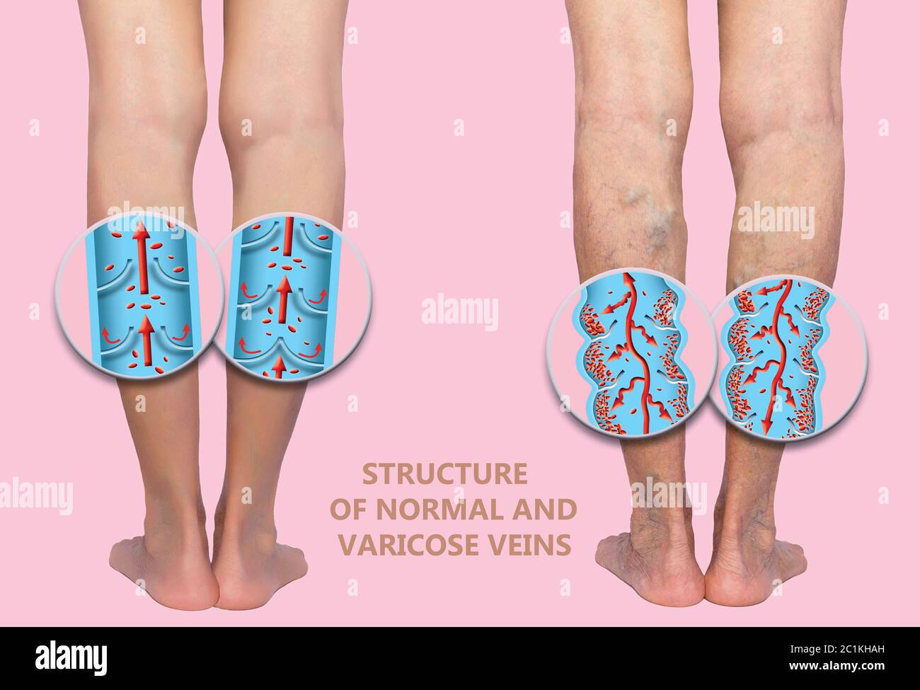 Krampfadern an den weiblichen älteren Beinen. Die Struktur der normalen und Krampfadern. Konzept von trockener Haut, älteren Menschen, Krampfadern und tiefer Venenthrombose oder DVT Stockfoto