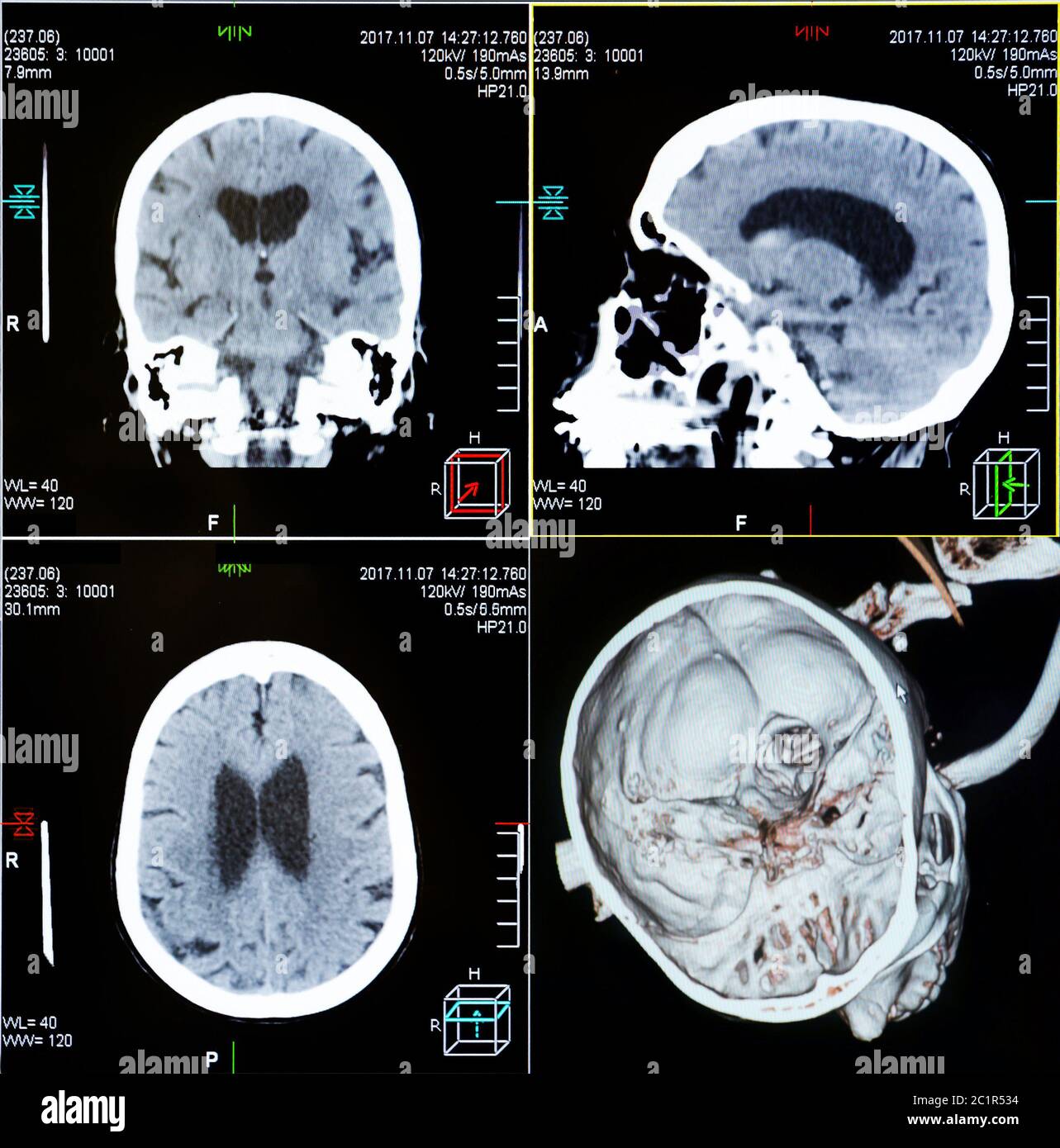 CT-Scans des menschlichen Kopfes Stockfoto