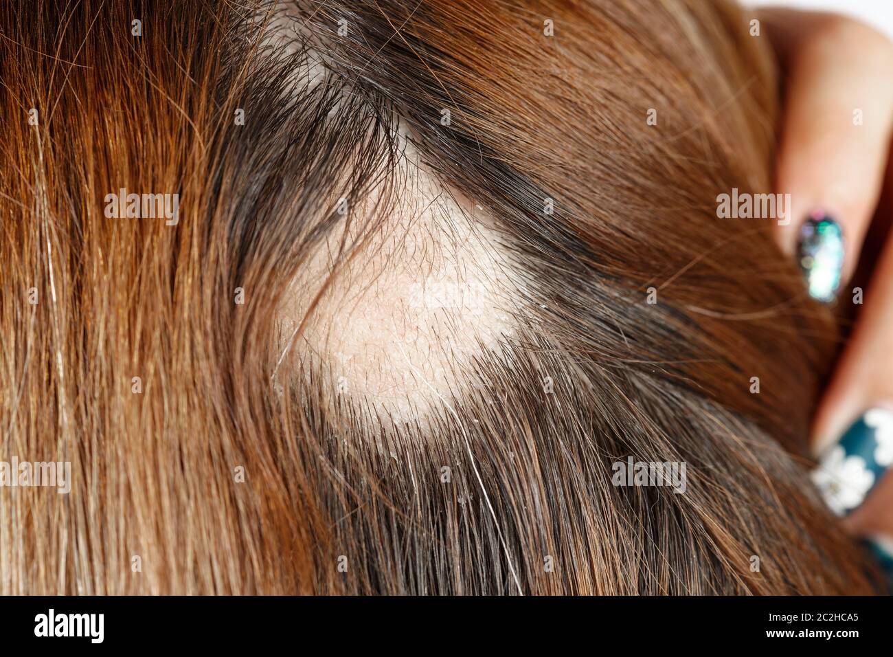 30 jährige Kaukasier Frau mit spot Alopezie, kahle Stelle auf dem Kopf Stockfoto