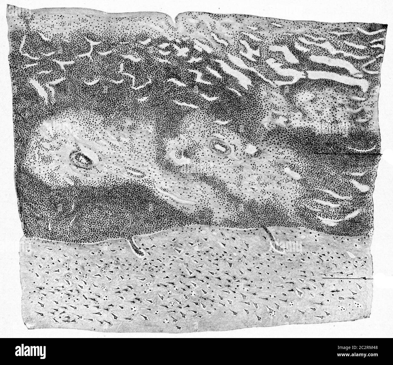 Schnitt der Großhirnrinde und Hirnhäute aus einem Fall von supurativer Meningitis, Vintage gravierte Abbildung. Stockfoto