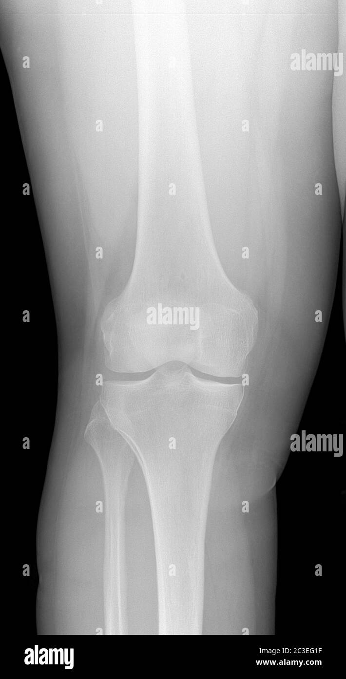 Bild des Knee-Röntgenstrahls. Erkennung Von Rradiographischer Kniearthrose. Stockfoto