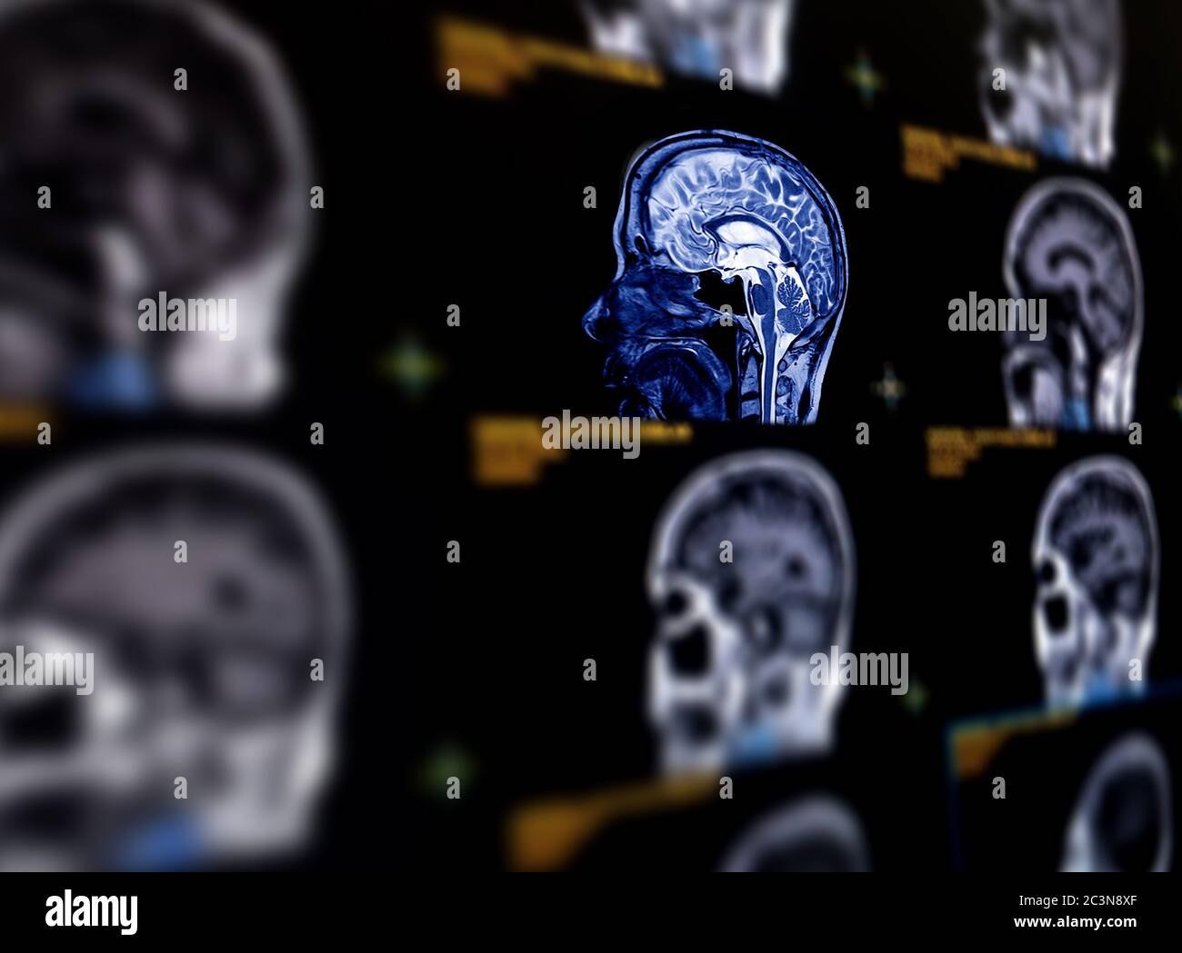 Selektive Fokussierung der sagittalen MRT-Hirnebene zur Erkennung einer Vielzahl von Erkrankungen des Gehirns wie Zysten, Tumoren, Blutungen, Schwellungen, Entwicklung A Stockfoto