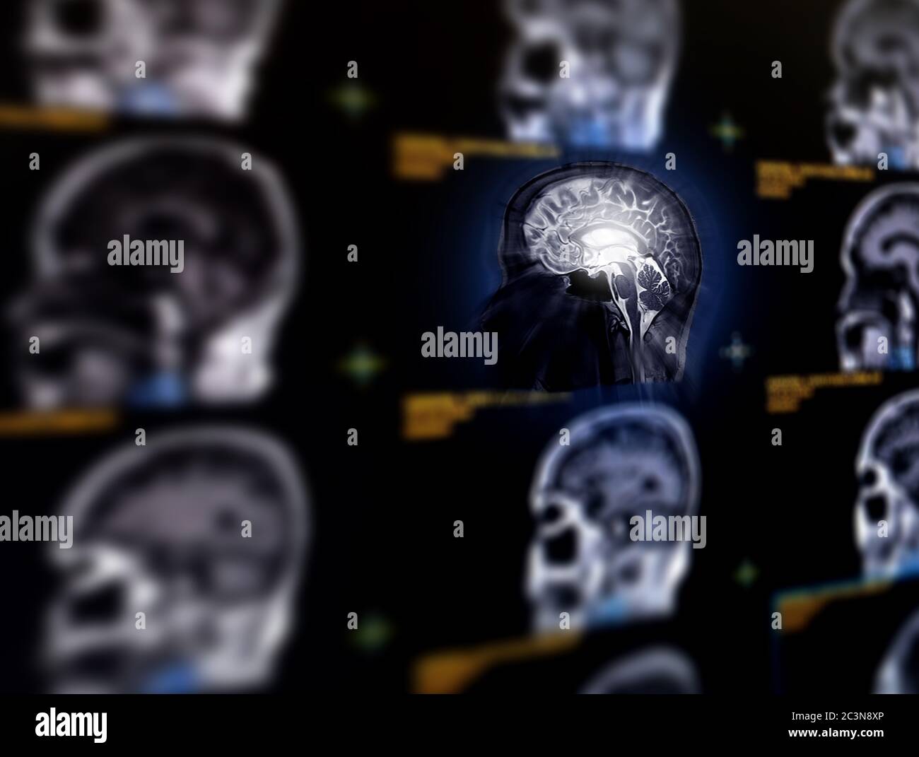 Selektive Fokussierung der sagittalen MRT-Hirnebene zur Erkennung einer Vielzahl von Erkrankungen des Gehirns wie Tumoren. Idee Konzept. Stockfoto