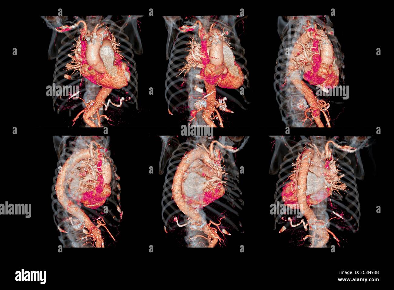 Sammlung von 3D-Rendering-Bildern der CTA-Thoraxaorta für diagnostische abdominale Aortenaneurysmen oder AAA- und Aortendissektion Stockfoto