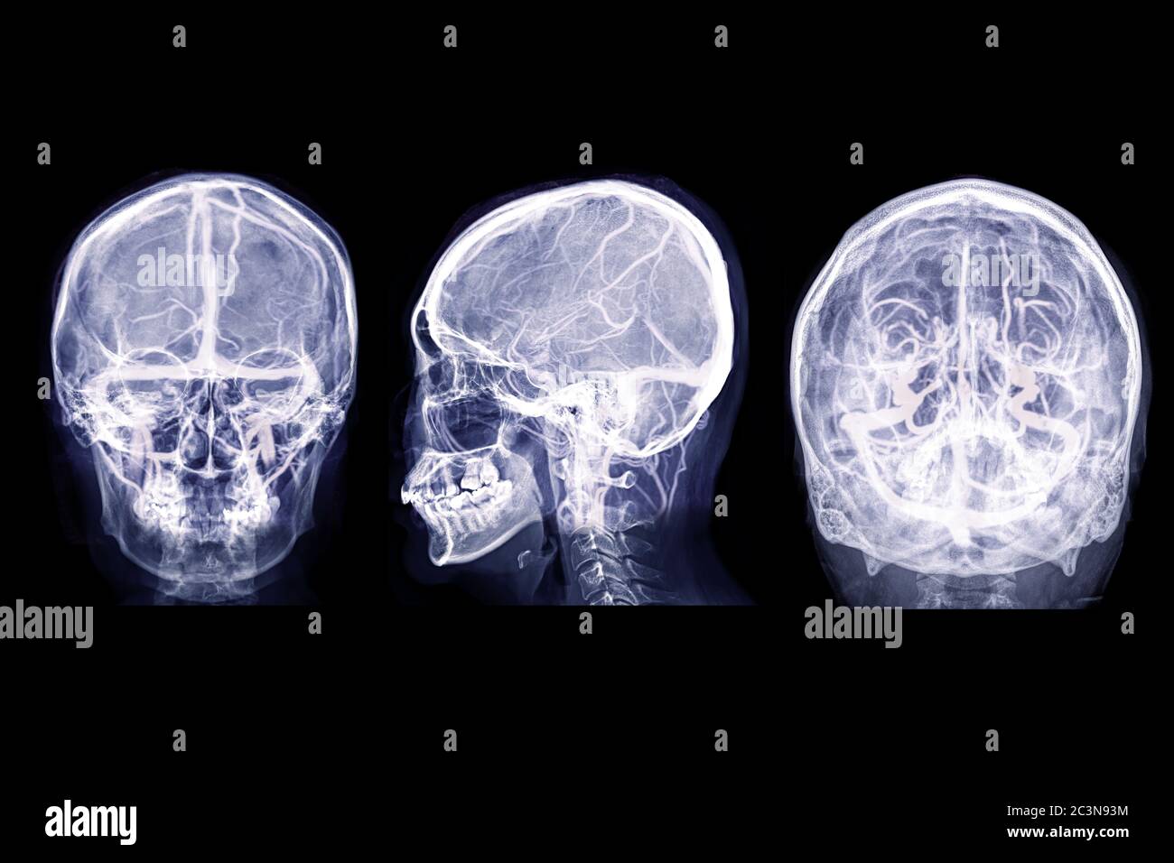 Sammlung von Schädel-Röntgenbild des menschlichen Schädels AP , Lateral und Wasser-Ansicht Mischung mit MRV Gehirn Bild zeigt venöse Nasennebenhöhlen des Gehirns im Schädel. Stockfoto
