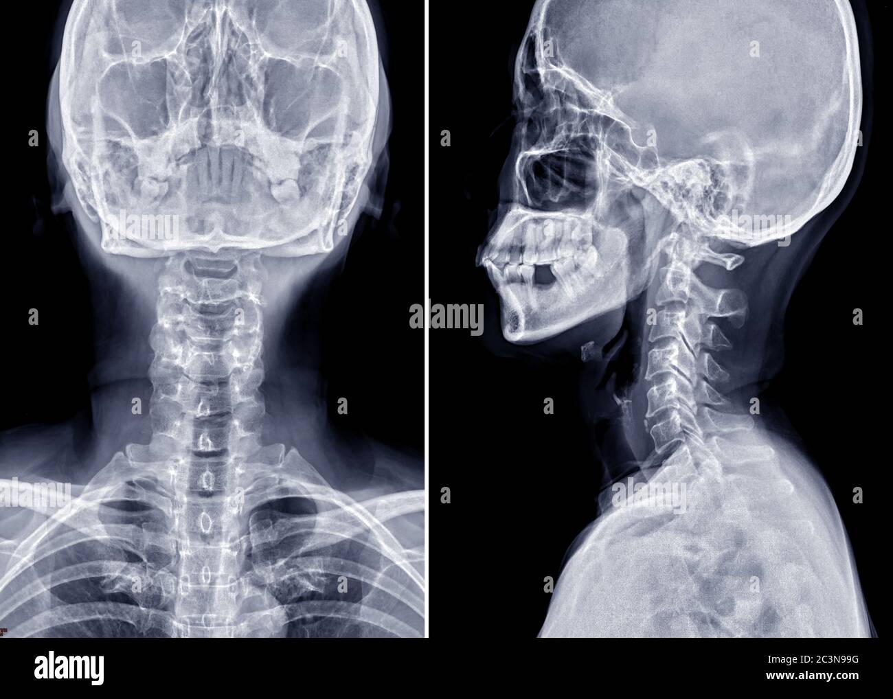 Röntgenaufnahme der Halswirbelsäule, AP und laterale Ansicht für diagnostische Bandscheibenvorfall. Stockfoto