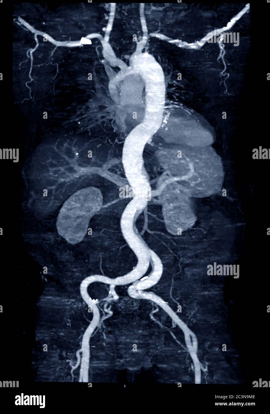 CTA Whoe Aorta mit Kurve MPR-Technik zeigt abdominale Aorta und linke, rechte Arteria iliaca zeigt Aortendissektion . Stockfoto