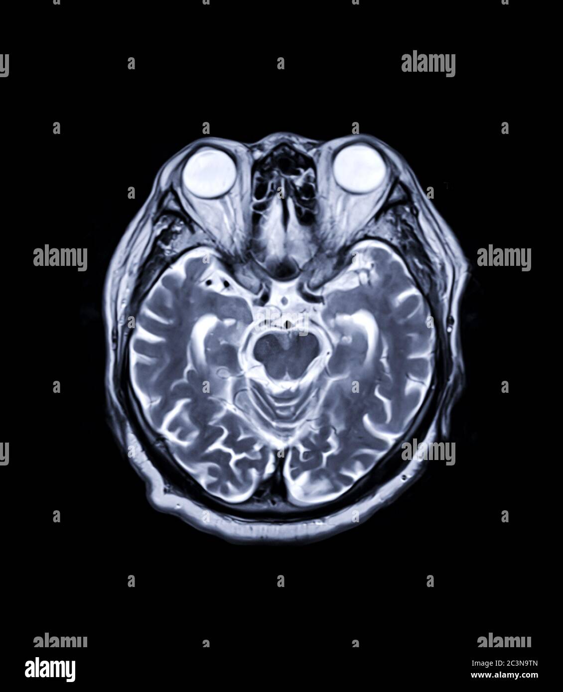 MRT Gehirn Axiale T2-Technik für die Detektion einer Vielzahl von Bedingungen des Gehirns wie Zysten, Tumoren, Blutungen, Schwellungen, Entwicklungs-und strukturellen Stockfoto