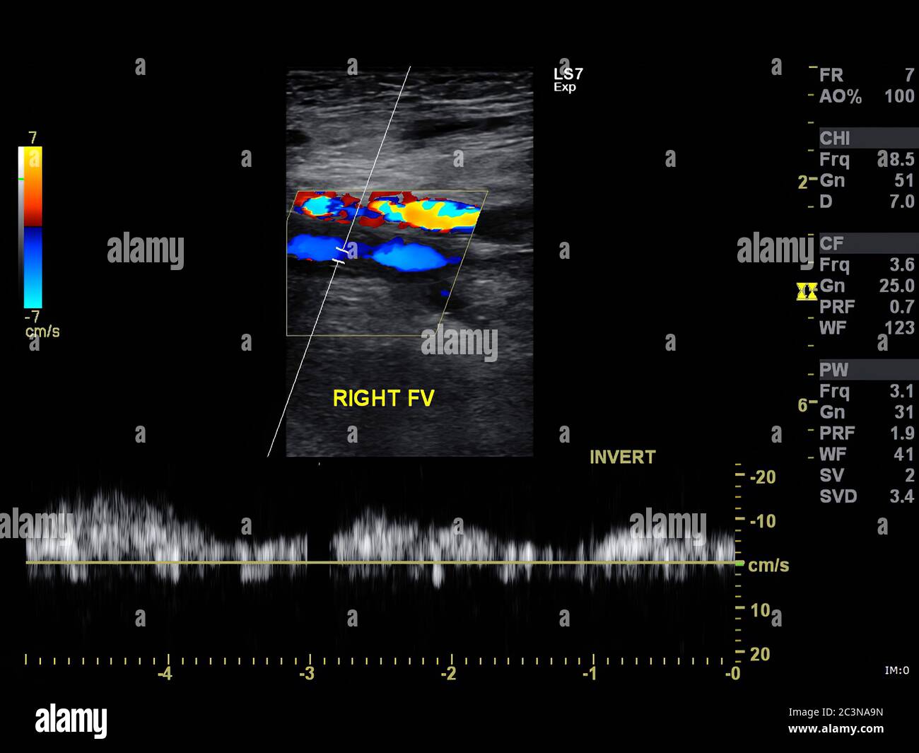 Ein Doppler-Ultraschallbild ist ein nichtinvasiver Test, der verwendet ...