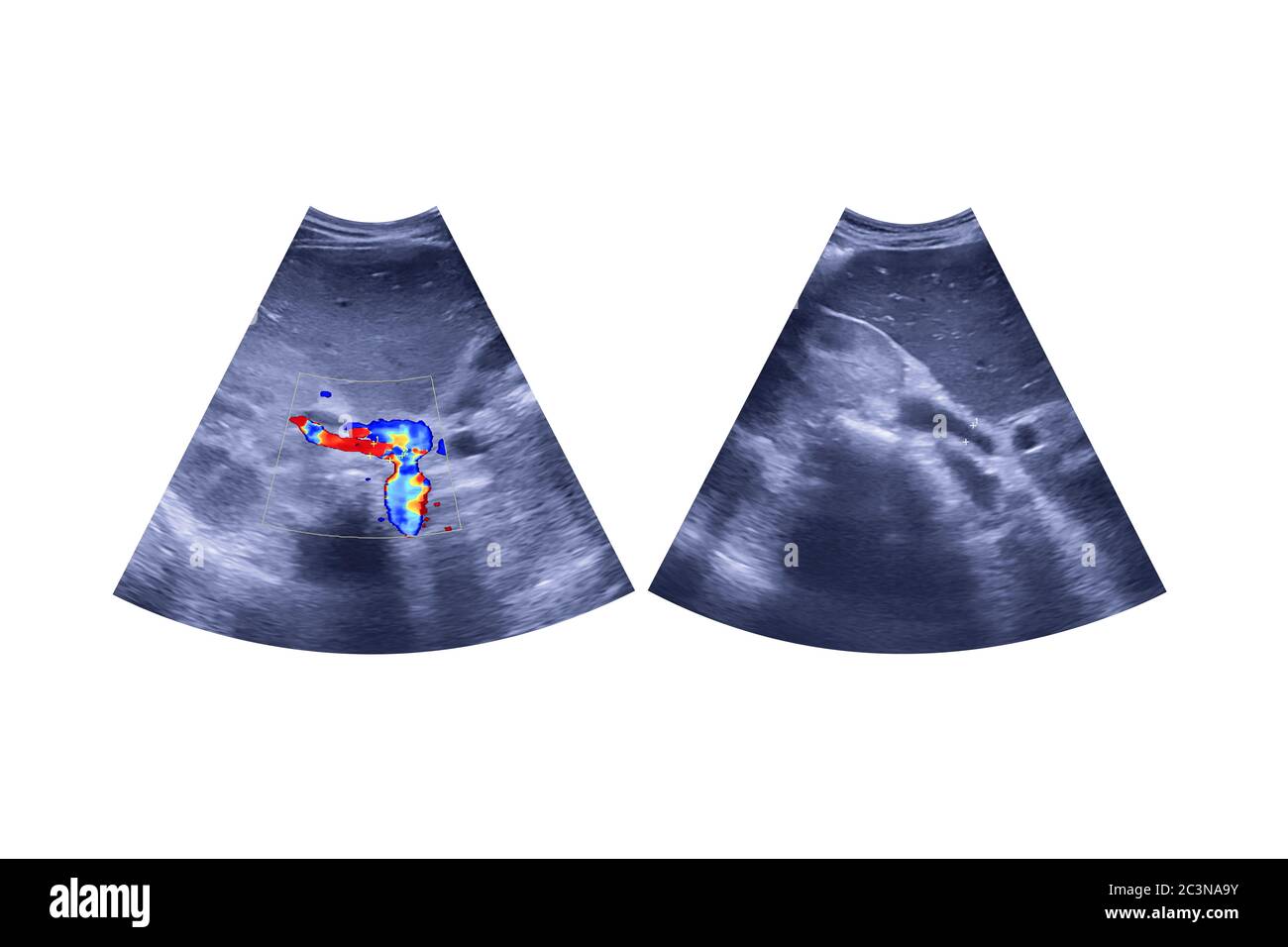 Ultraschall Oberbauch zeigt und Leber und Gallenblase für Screening Leberzellkarzinom von hcc isoliert auf weißem Hintergrund. Clipping Path. Stockfoto