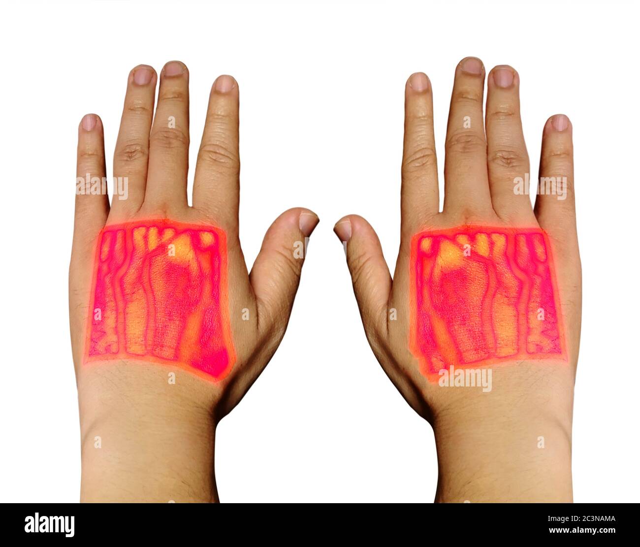 Venen-Finder-Handinfrarot beider Hände mit Cephala- und Basilikavene für Blutprobenuntersuchung Stockfoto