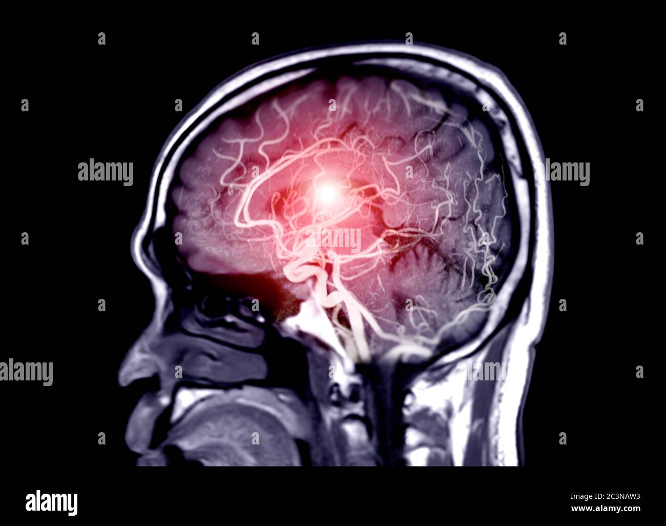 MRA Gehirn oder Magnetresonanzangiographie ( MRA ) der Hirnarterie im Gehirn Sagittal Ansicht für sie bewerten Stenose und Schlaganfall-Krankheit. Stockfoto