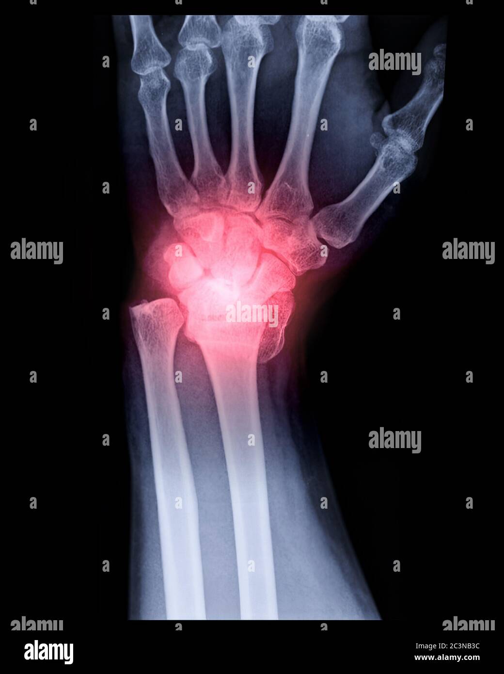 Röntgenbild der AP-Ansicht des linken Handgelenks zur Darstellung der Fraktur des Radiusknochens. Stockfoto